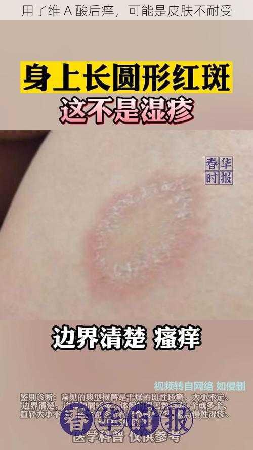 用了维 A 酸后痒，可能是皮肤不耐受
